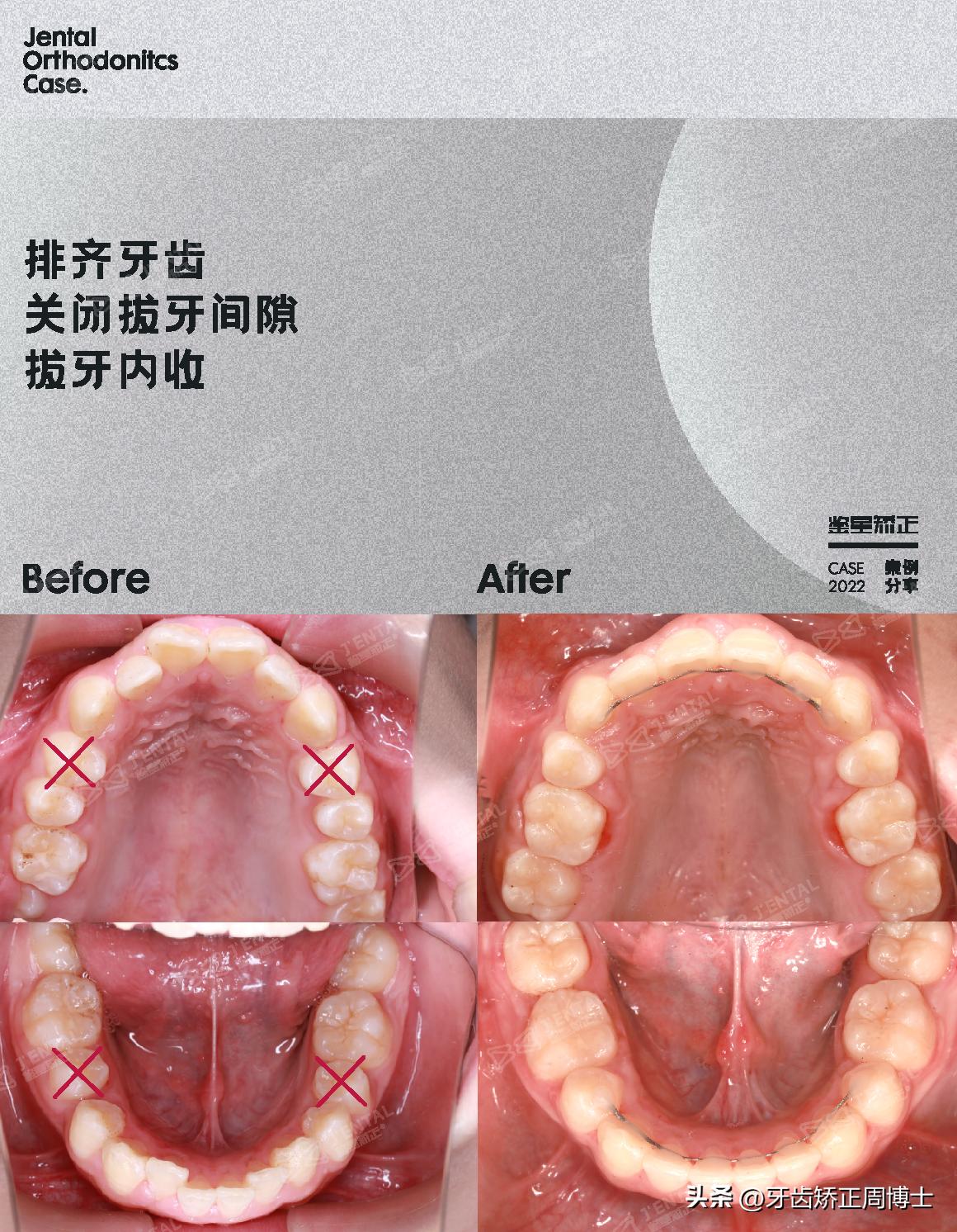 mrc戴上后不能闭上嘴怎么办,mrc矫正能用到几岁