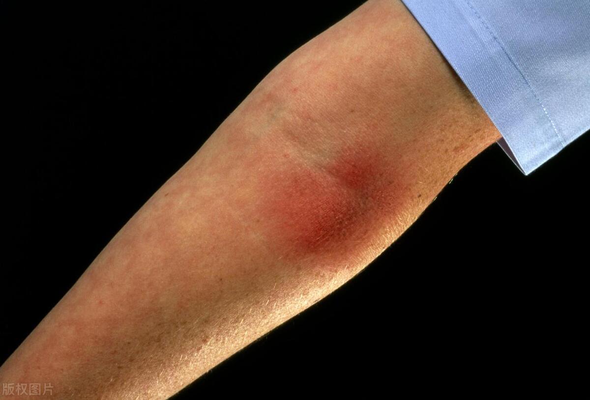 13岁女孩湿疹反复发作怎么办,年轻女孩湿疹是什么原因造成的