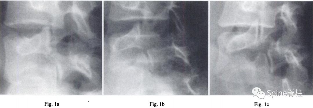 峡部裂和隐性峡部裂有区别吗,单纯峡部裂可以做峡部修复吗