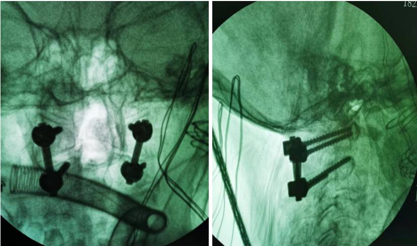 四川南江成功救治一齿状突骨折并寰枢椎脱位患者