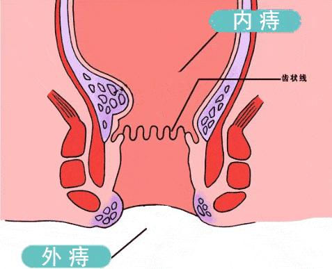 拉屎太用力有什么后果,拉屎便秘快速解决小妙招