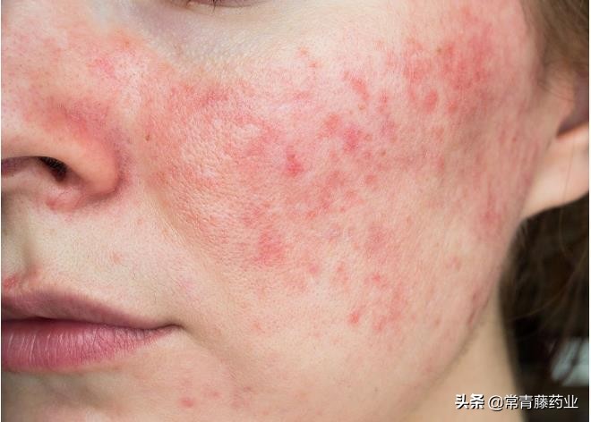 脸蛋泛红不痛不痒是怎么回事,玫瑰痤疮脸上泛红怎么治疗