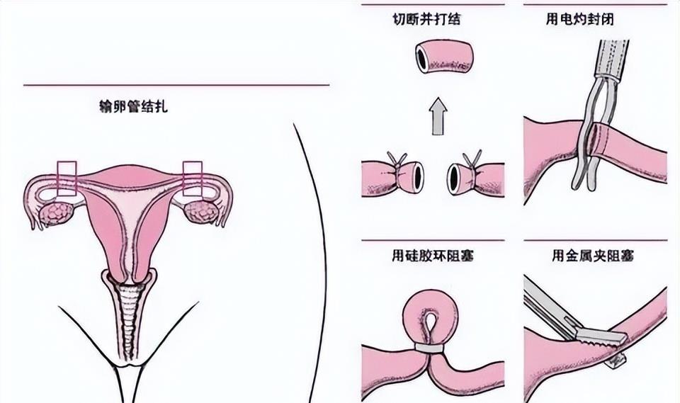 男子结扎1年后妻子竟怀孕医院被判赔偿1万4究竟怎样避孕才靠谱？
