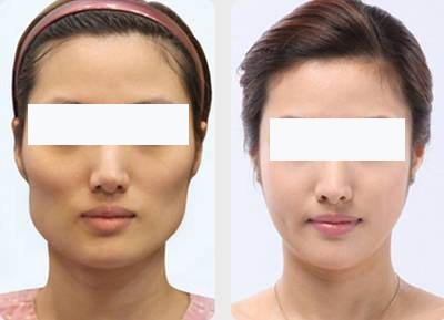 有颧骨的人怎么会显的好看,高颧骨是显老还是显年轻