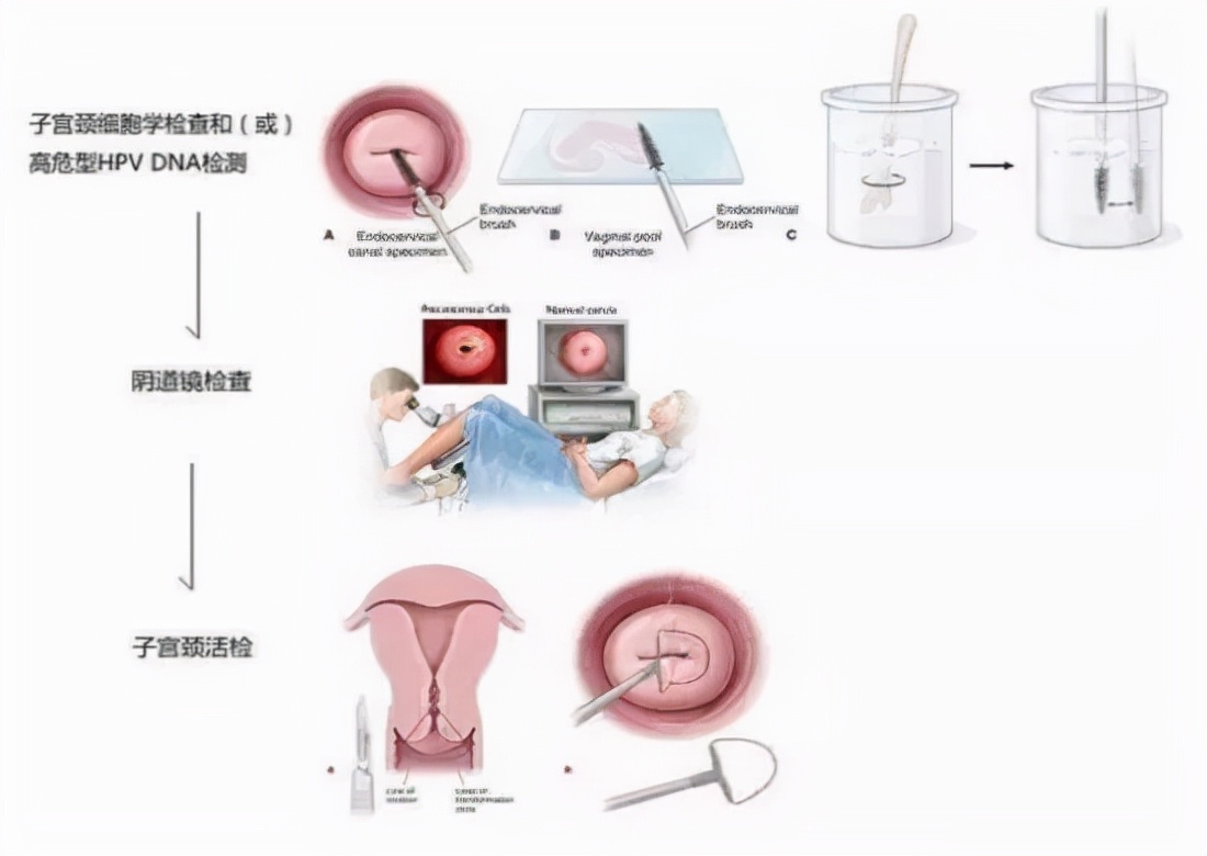 阴道镜检查，你要注意什么？