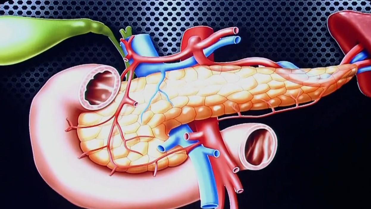 胰十二指肠切除的并发症,胰十二指肠切除术后胰瘘多久能好