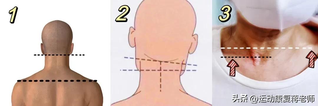 歪头斜脖子矫正方法,歪头歪脖怎么矫正