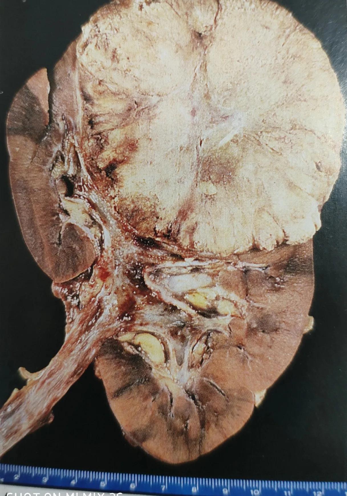 体检发现肾上有肿瘤怎么办,体检肾有个肿块是怎么回事