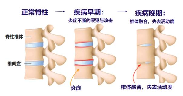 确诊强直性脊柱炎去买什么药吃,如何才能确诊强直性脊柱炎