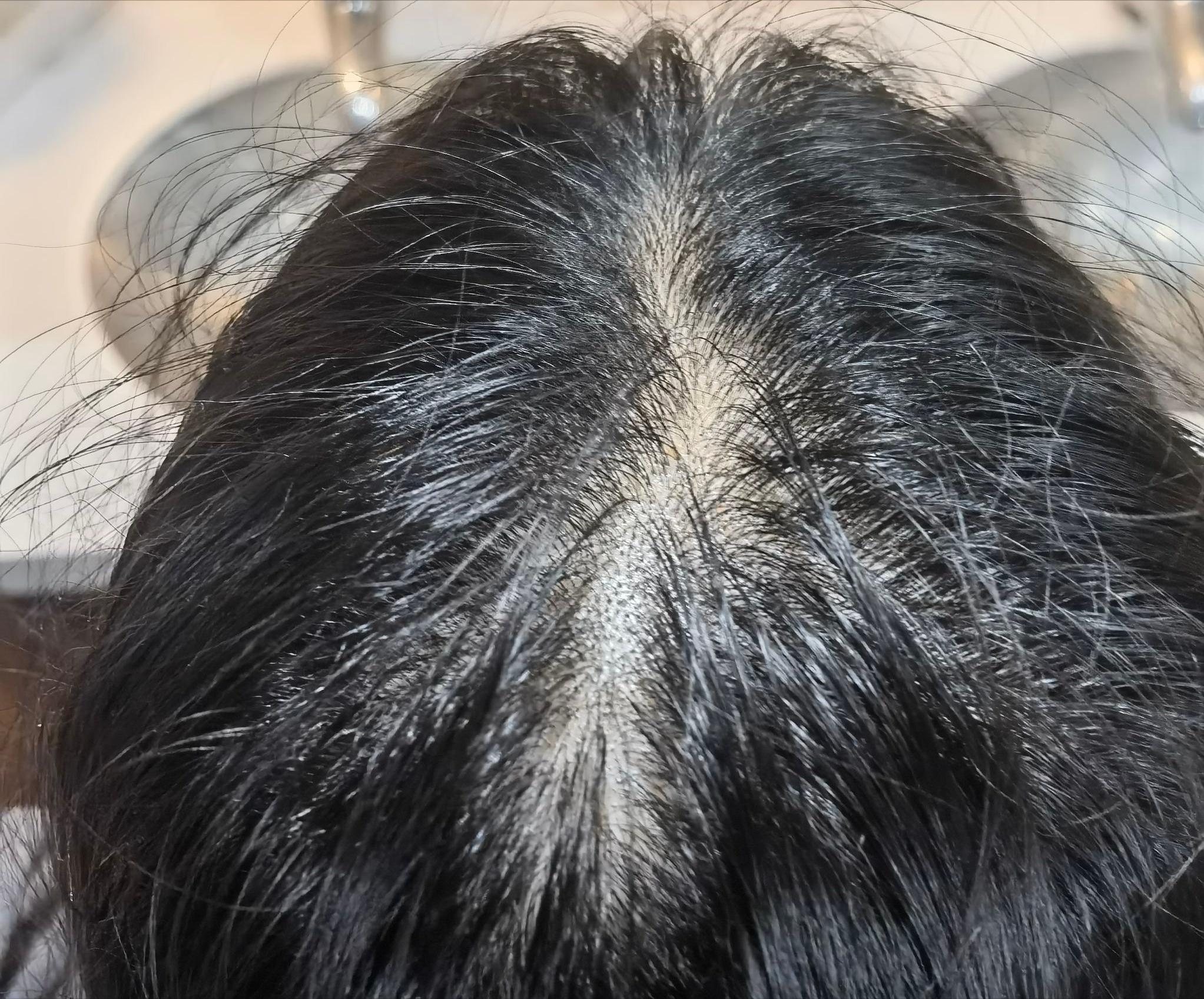 使用米诺地尔两个月长头发,使用米诺地尔五个月照片