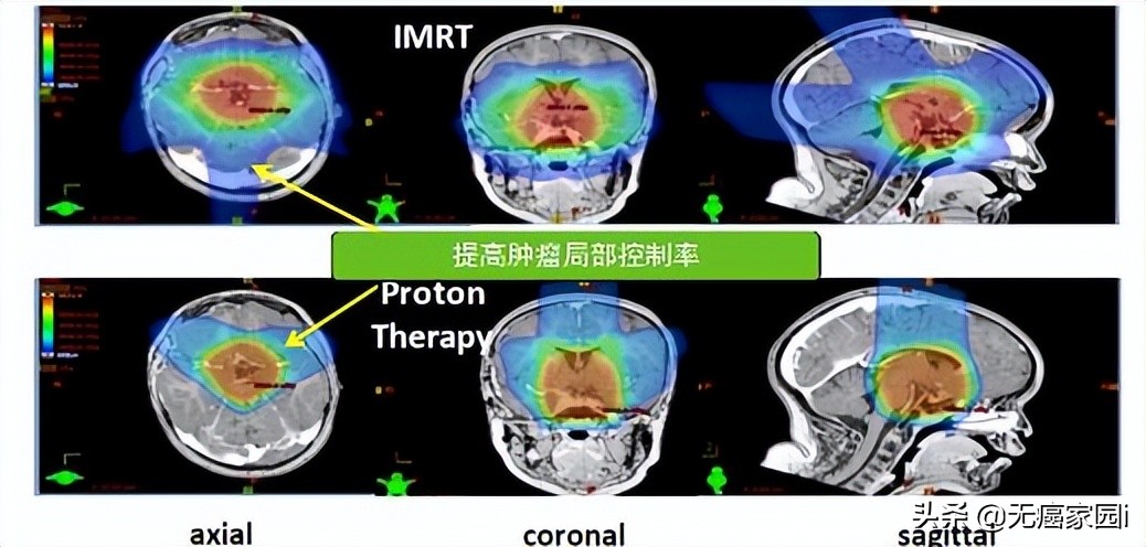 脑瘤、肺癌及儿童肿瘤等不妨考虑质子治疗,疗效和生存质量双保障