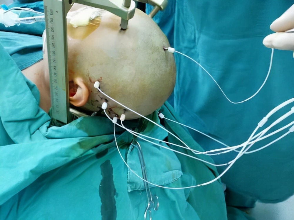 癫痫热凝毁损手术治疗成功率,癫痫痴笑发作