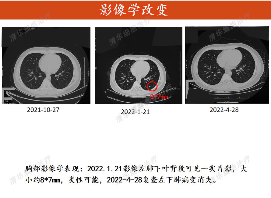 确诊肠癌了该怎么办,确诊癌症先别绝望
