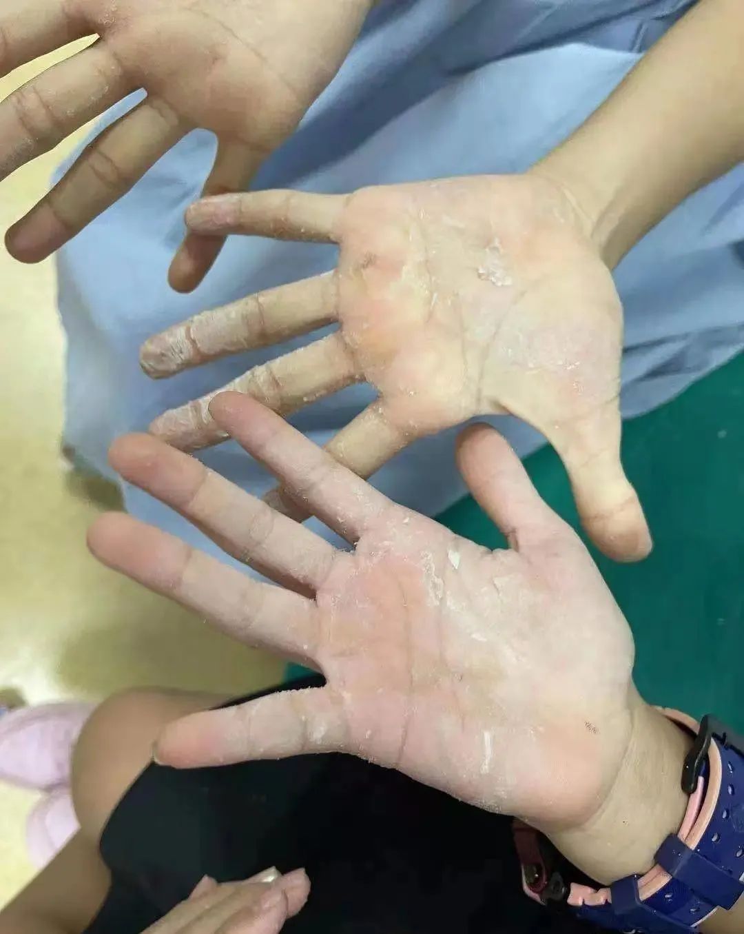 眼睛被热水溅到怎么处理,502不慎溅入眼睛要冲洗多久