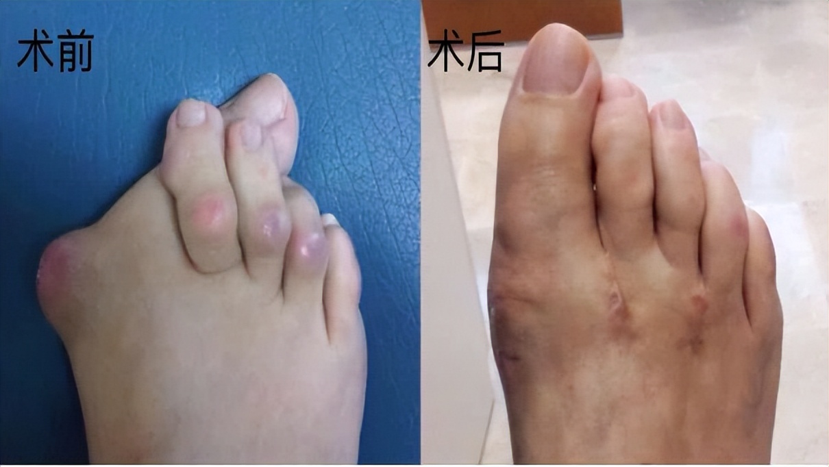 大拇脚趾往里歪怎么矫正,严重拇外翻脚趾畸形怎么办