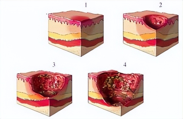治褥疮的药膏有哪些,得了褥疮在家怎么治