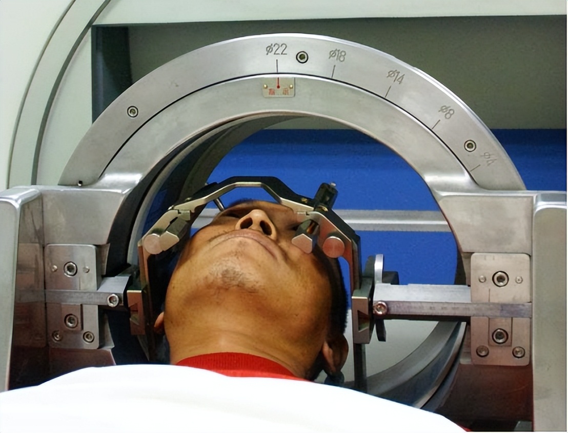 三叉神经痛伽玛刀可以维持多久,三叉神经痛伽玛刀有哪些副作用