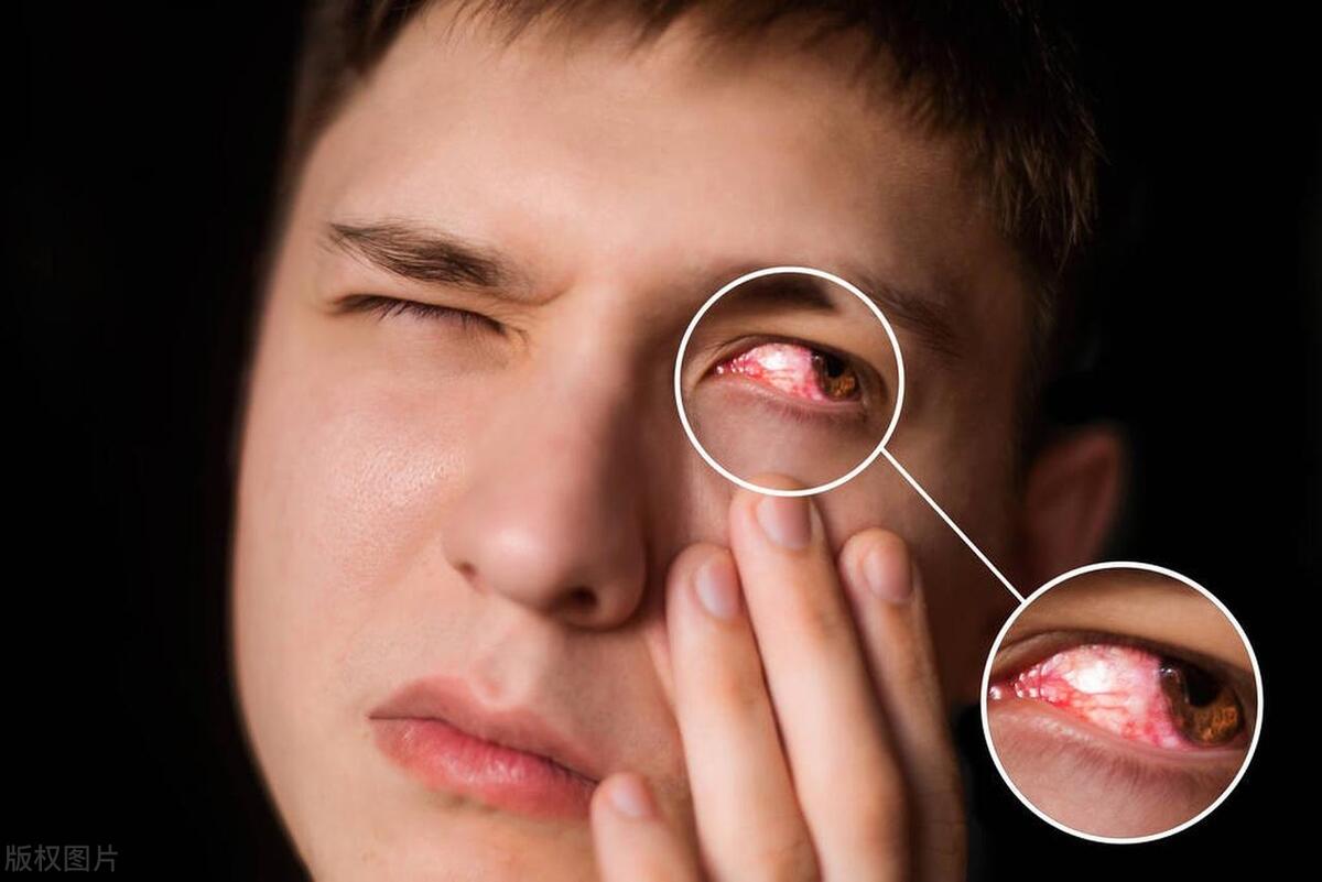 眼睛红肿疼痛的角膜炎有什么药,角膜炎眼皮内有白色东西红肿