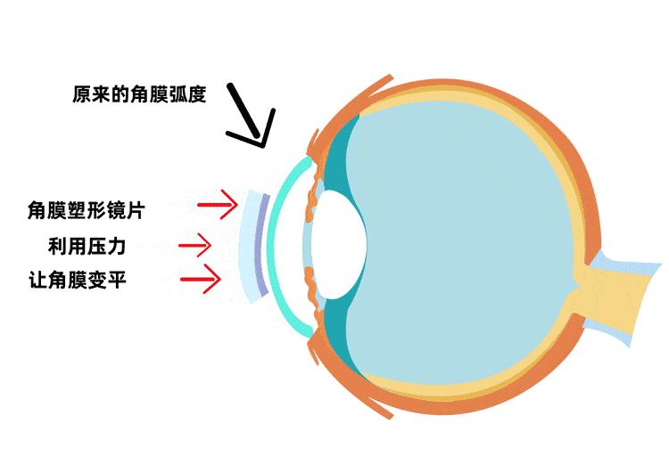 打篮球适合戴ok镜,戴半框眼镜能打篮球吗