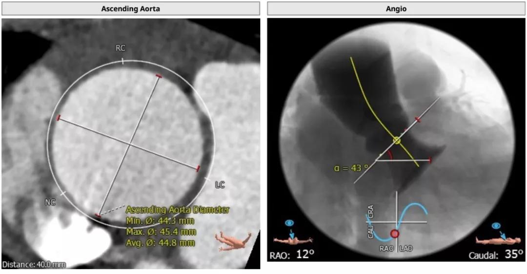 主动脉瓣狭窄病例讨论,25岁主动脉瓣狭窄用什么治疗方案