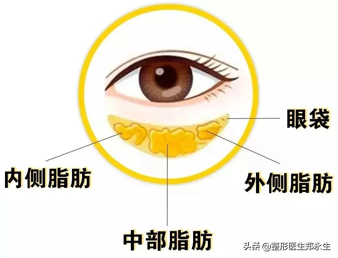 有眼袋消除小妙招,有眼袋了小妙招消除