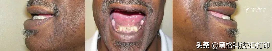 病例分享|美国BDG诊所实现全口即刻修复病例一则