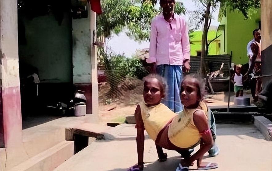 印度连体姐妹嫁给男子,印度男娶连体姐妹