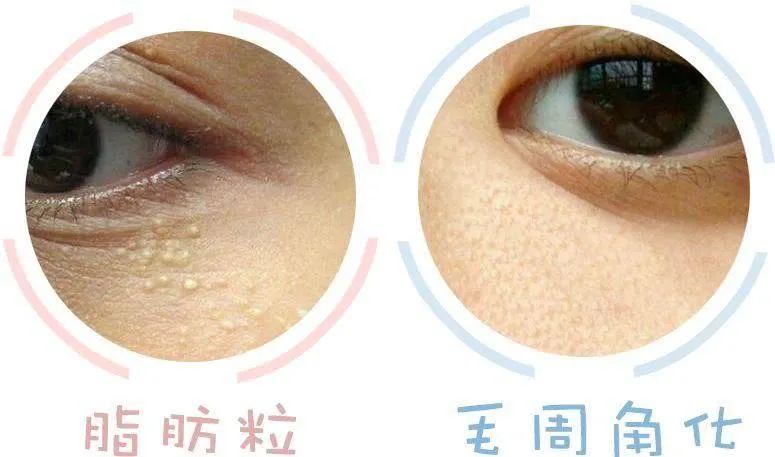 舒善：如何快速区分脸上的白色小疙瘩？