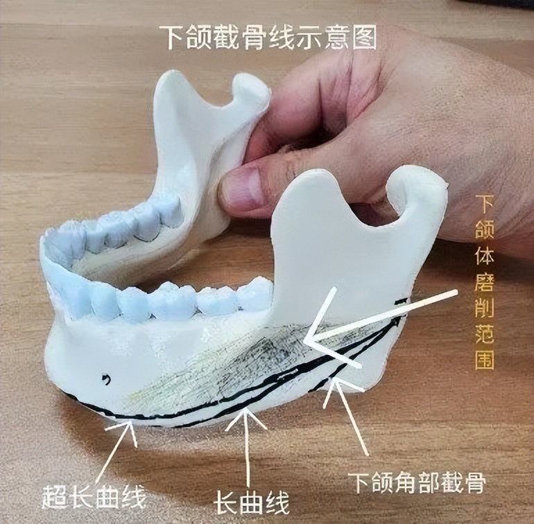 下颌角整形全过程视频,下颌整形手术的护理措施有哪些