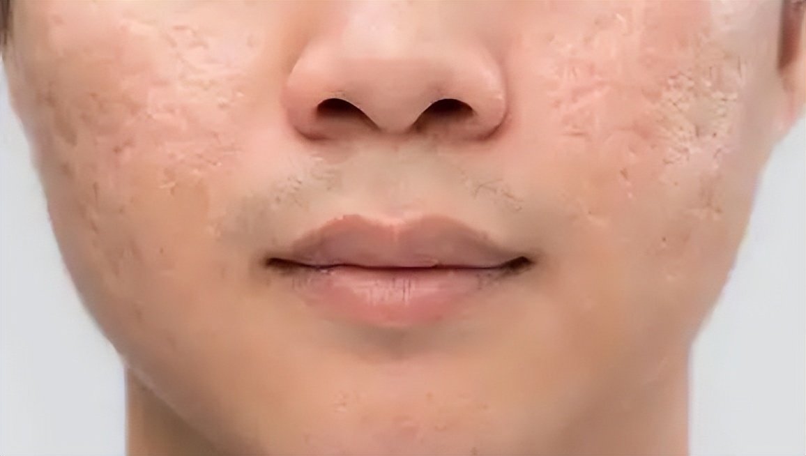 医学那么发达为什么治不了痘坑,想治痘坑但没钱怎么办