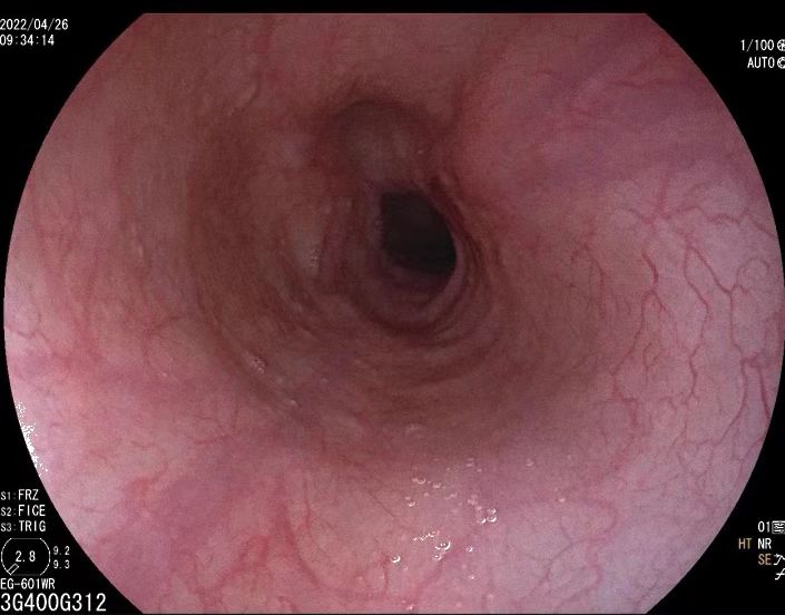 胃片怎么拍,胃造影的流程