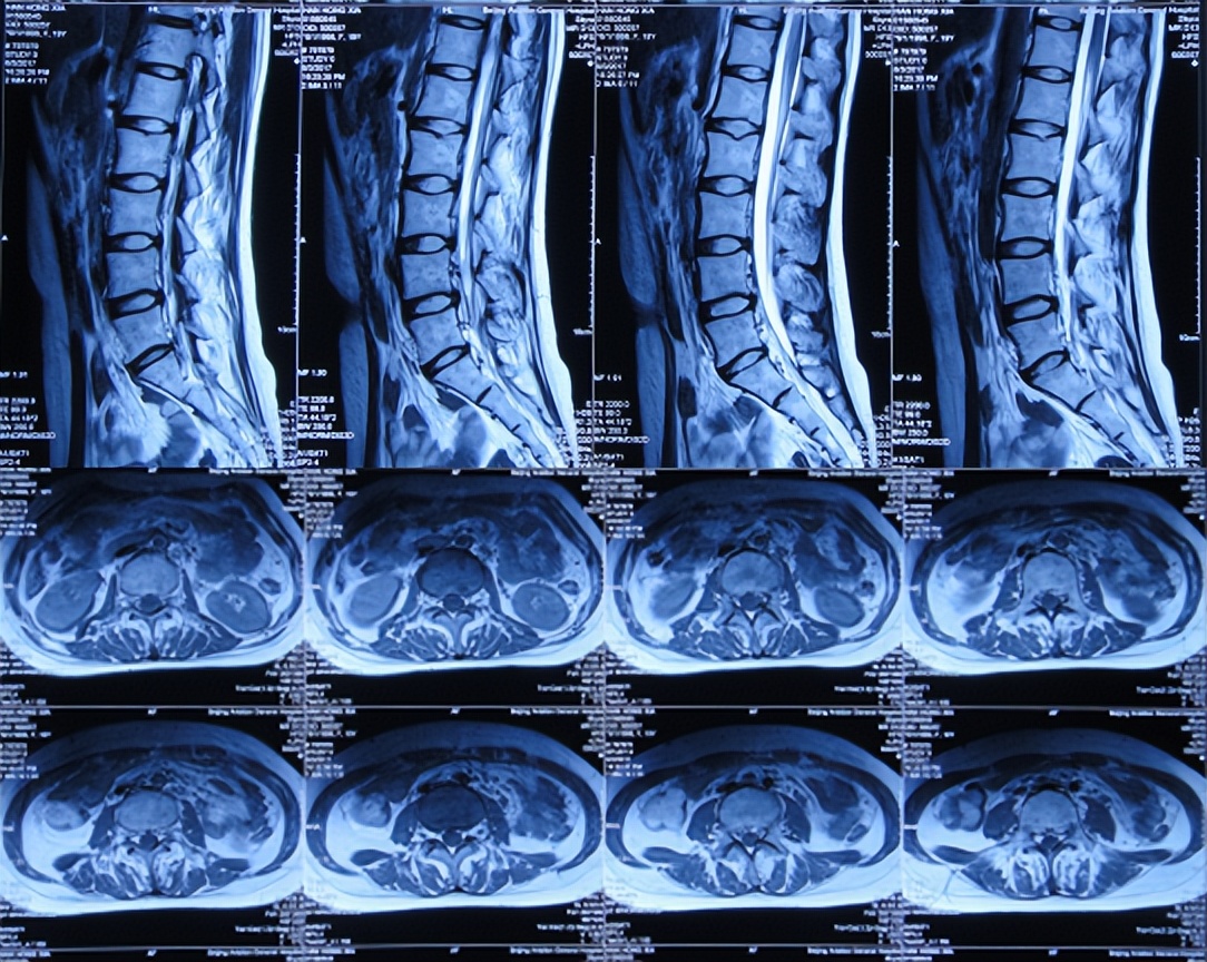 结核脑炎型脑积水怎么治,结核性脑膜炎2期很严重吗