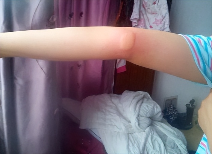 被蚊子咬掐十字止痒法,被蚊子叮咬后掐十字有用吗