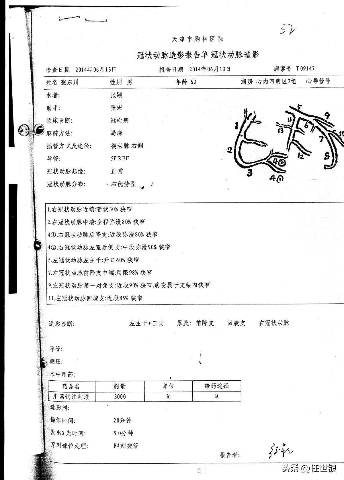 重症冠心病的新法治疗系列病例报导之四