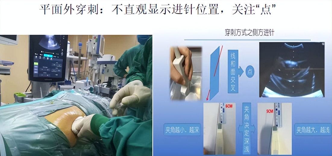 明知山有虎,偏向虎山行——肾斗士VS肾结石