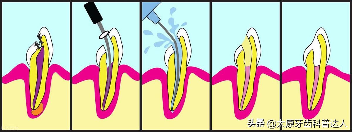 什么情况下需要剔掉牙神经,什么情况需要抽牙神经
