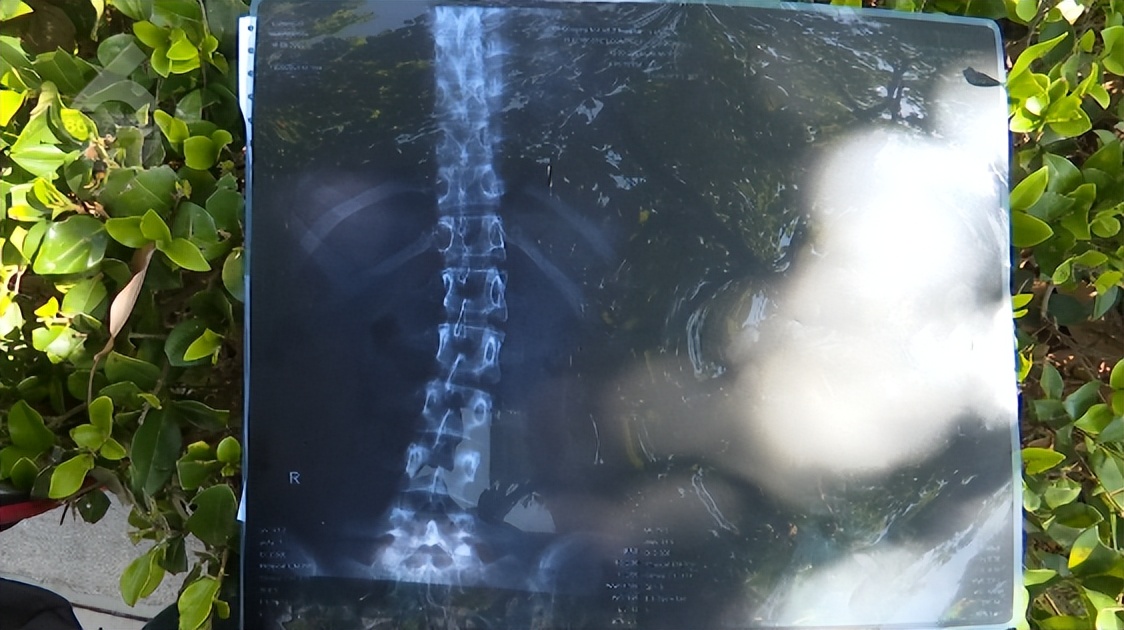 女孩学舞蹈被老师压骨折,女子学瑜伽时被教练压骨折