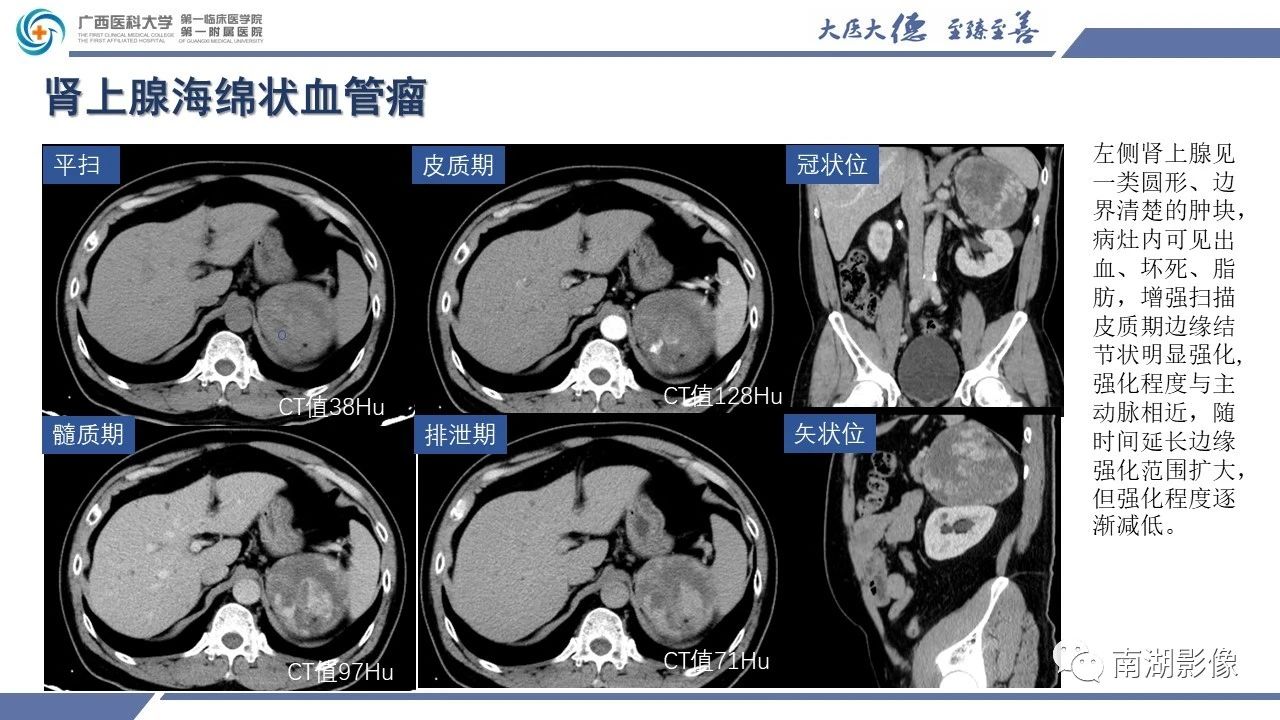 肾上腺海绵状血管瘤,肾上腺血管瘤是良性还是恶性