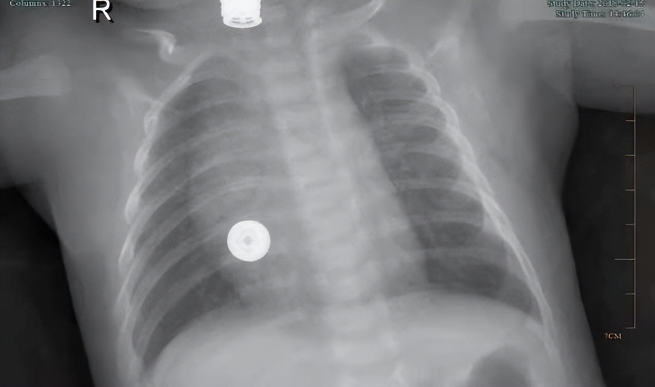 出生1天肺炎住院,出生21天宝宝肺炎住院