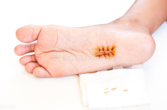 伤口拆线有一针没拆到怎么办,伤口拆线后拆线部位硬硬的