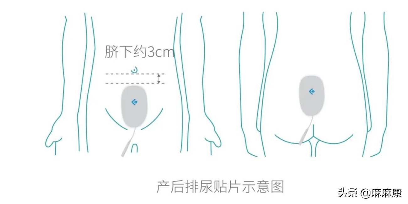 产后尿潴留的原因及处理方法,解除产后尿潴留首选的护理措施是