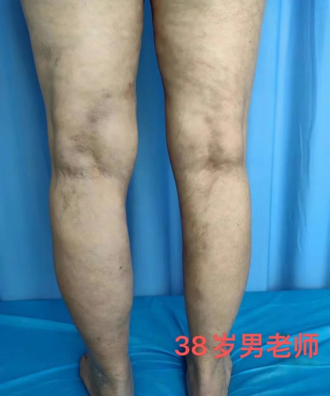 静脉曲张微创治疗什么医院最好,静脉曲张激光光纤消融术