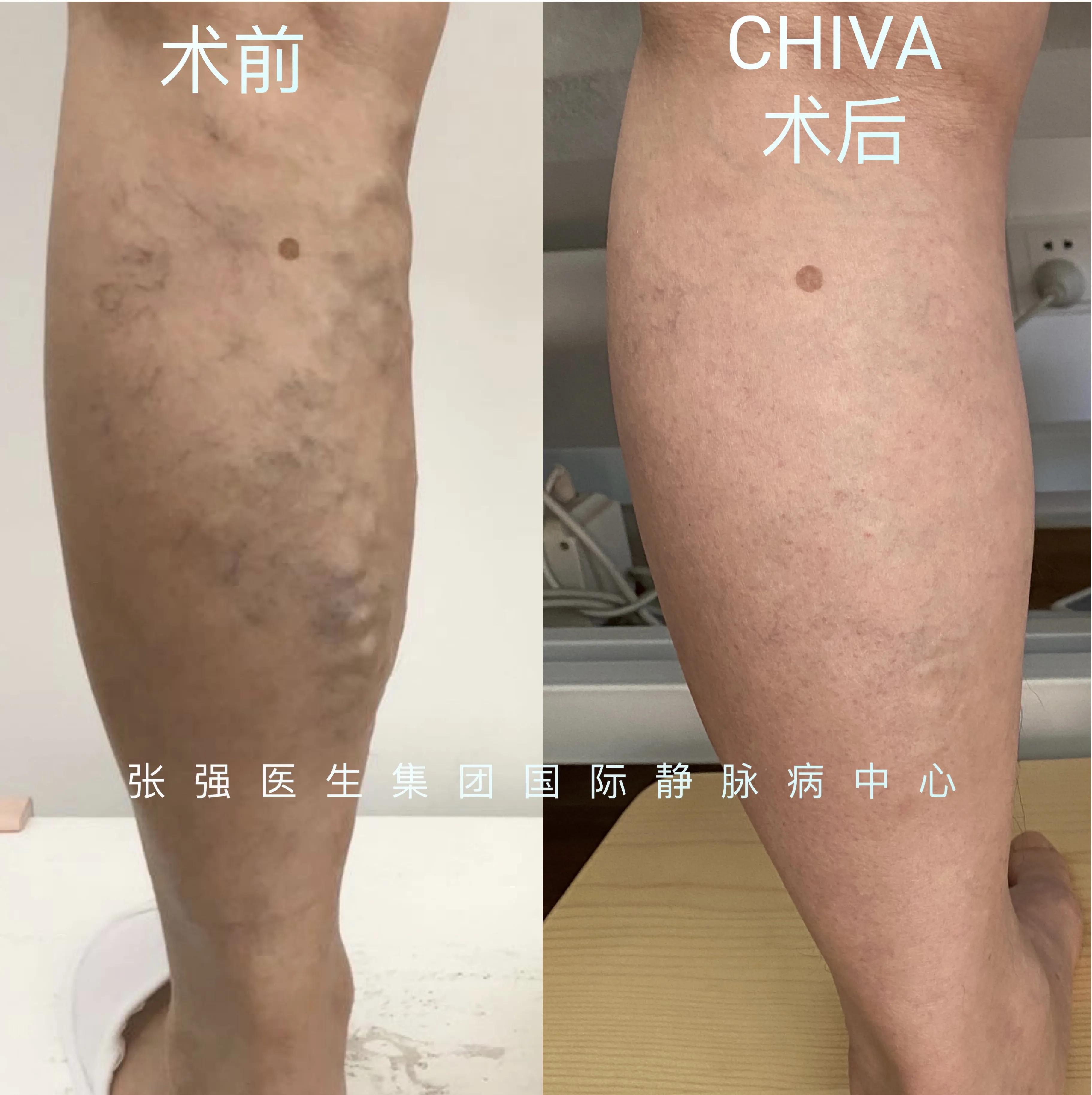 臭氧治疗静脉曲张好不好,臭氧疗法治疗静脉曲张效果怎么样