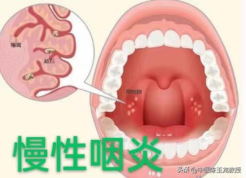 滤泡性咽喉炎中药方子,咽喉炎扁桃体炎常用中药