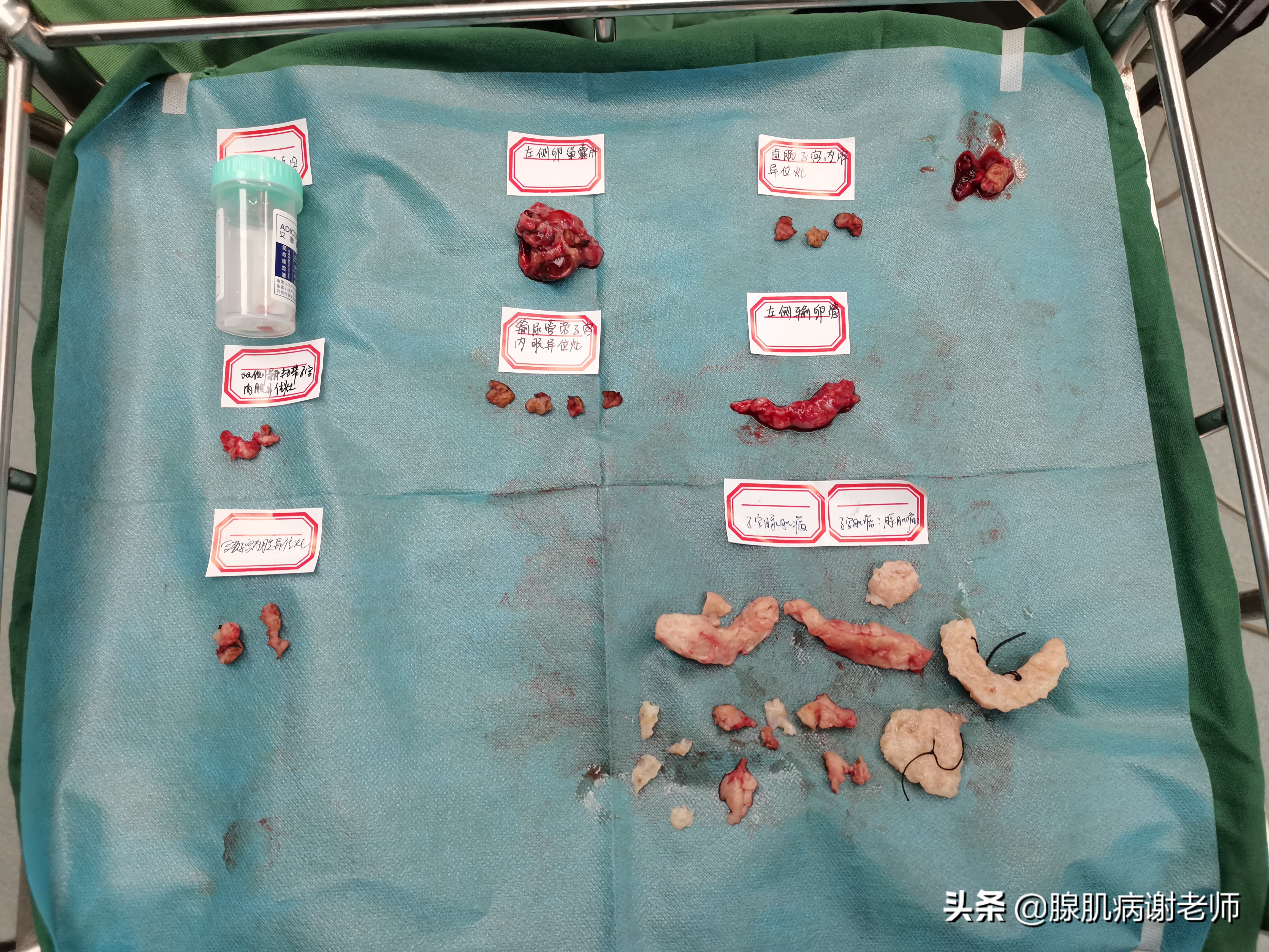 腺肌症排卵期像来月经一样痛,腺肌症是不是快来月经开始痛