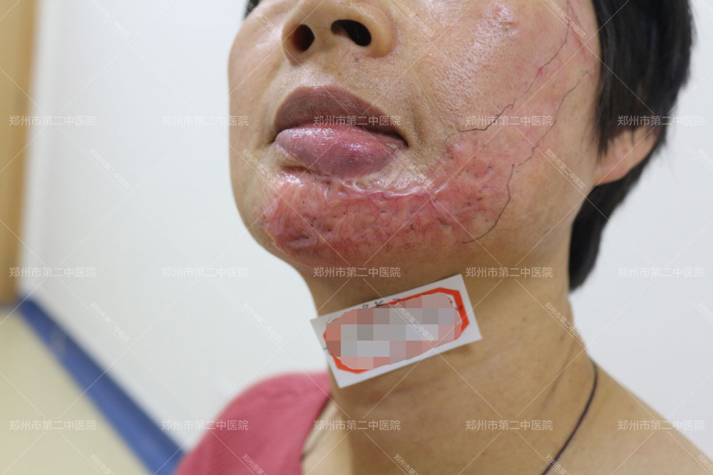 郑州提供疤痕修复多少钱,郑州市哪里修复疤痕最好