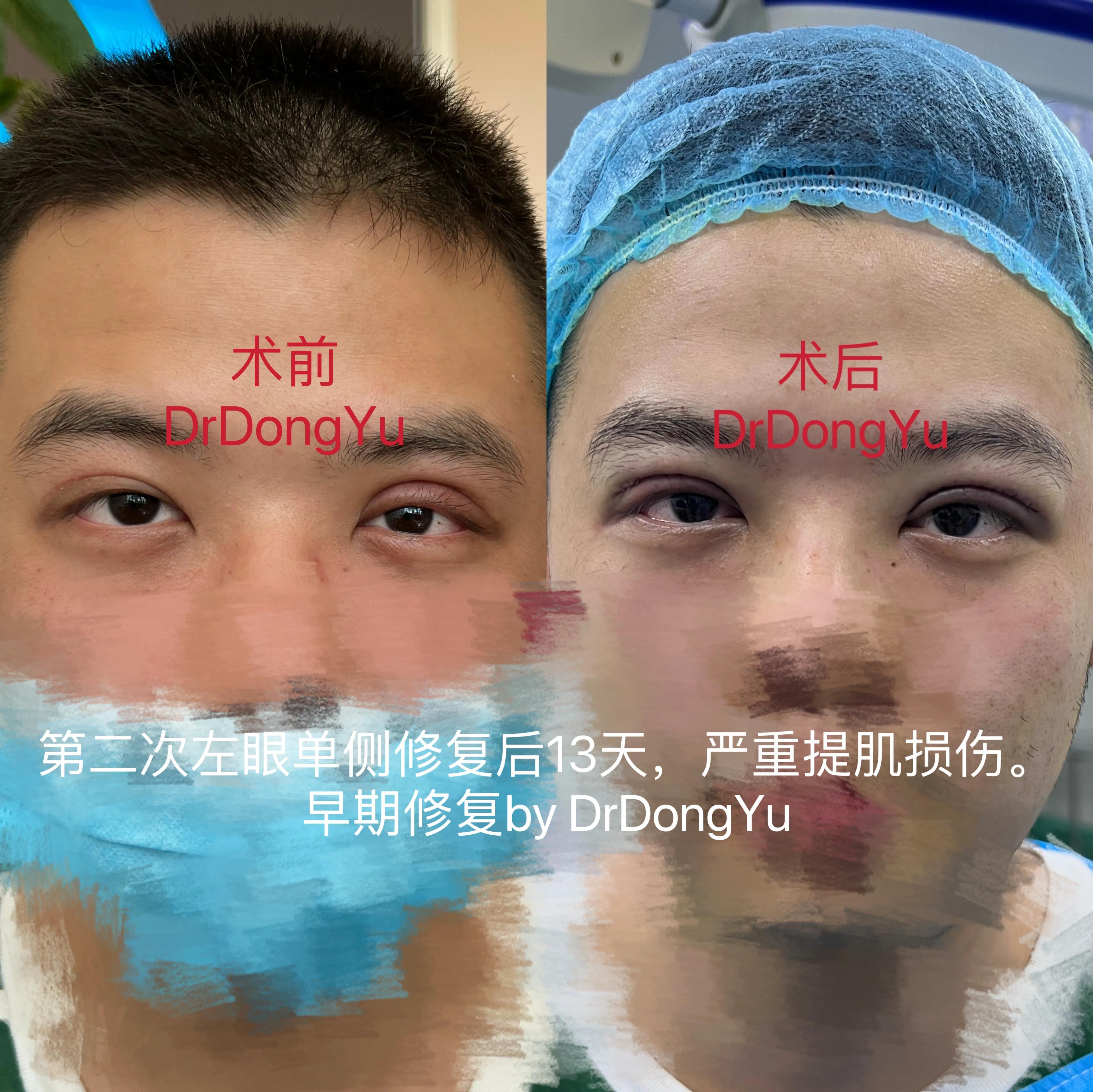 提肌手术多长时间能恢复,严重受损发质修复