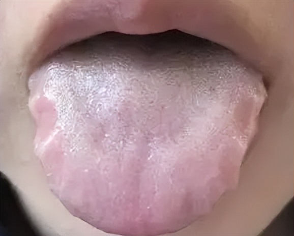 中医看舌苔｜这是不是你家小孩的舌苔？