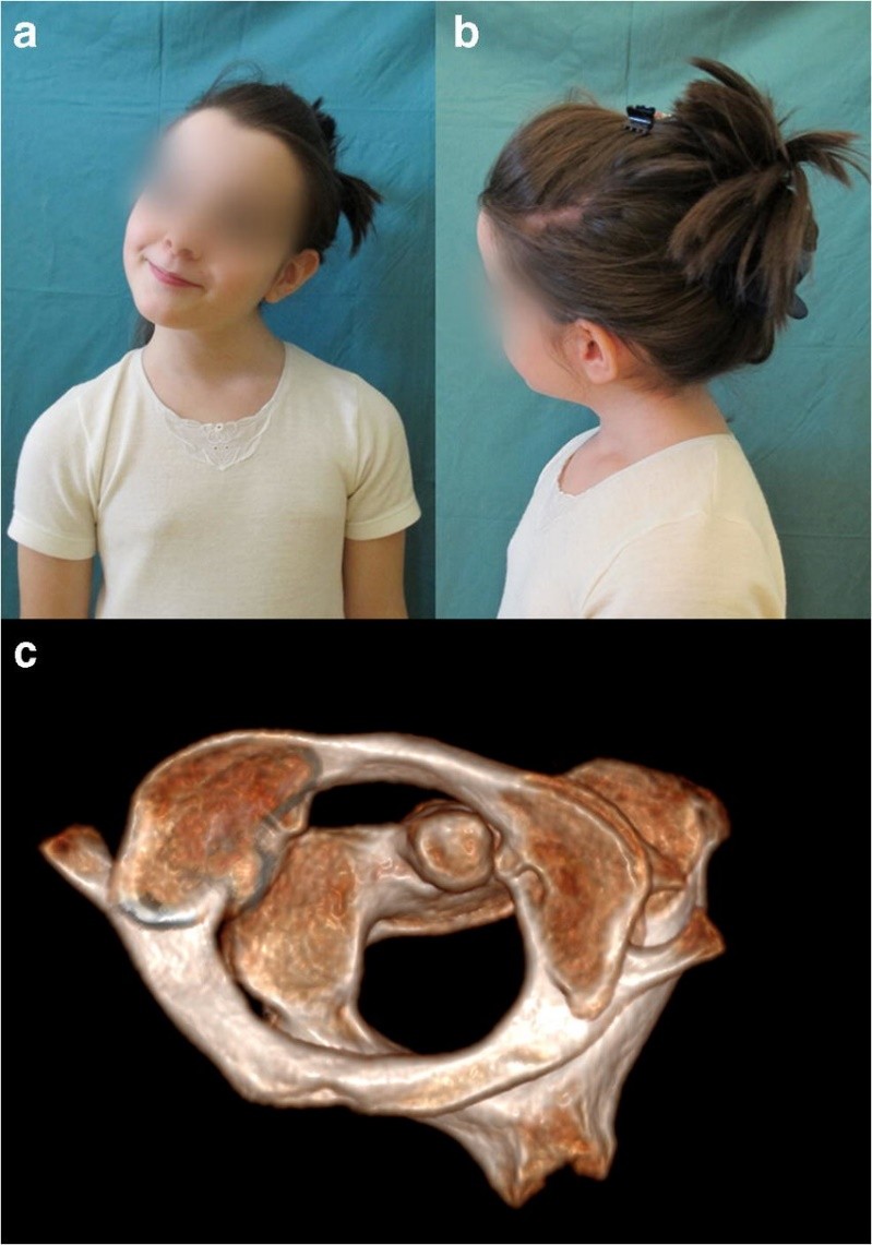 儿童落枕最快恢复办法,落枕了30秒自愈方法儿童