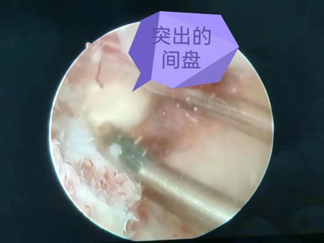 微创脊柱外科护理创新100个小点子,聊城市第二人民医院脊柱外科